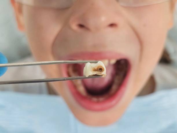 Best Emergency Tooth Extraction in Soda Springs, ID
